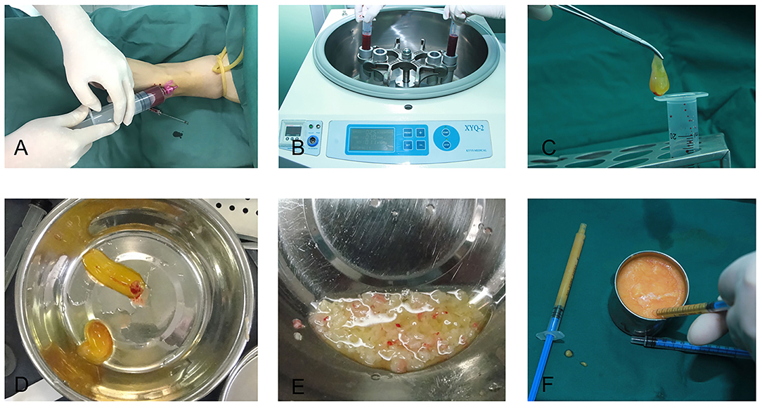 Frontiers | Platelet-Rich Fibrin in Fat Grafts for Facial