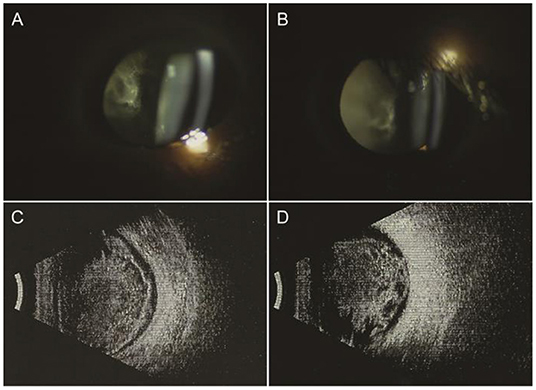 Frontiers | Case Report: Vitreous Amyloidosis Caused by a