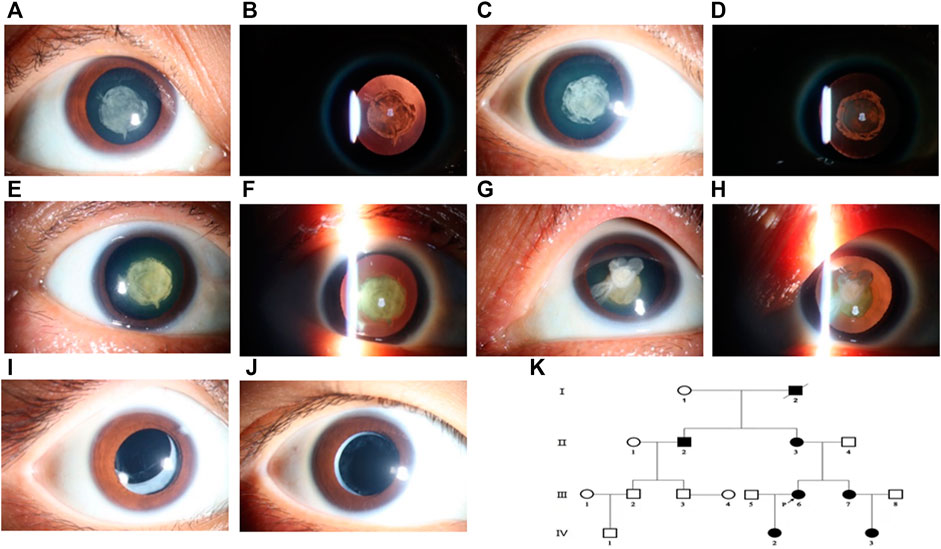 Frontiers | Case Report: A Novel Mutation in the CRYGD Gene