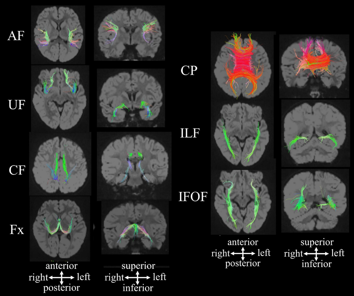 売り切れ必至！ Structural Quantitative | Frontiers Brain Resonance Magnetic 洋書