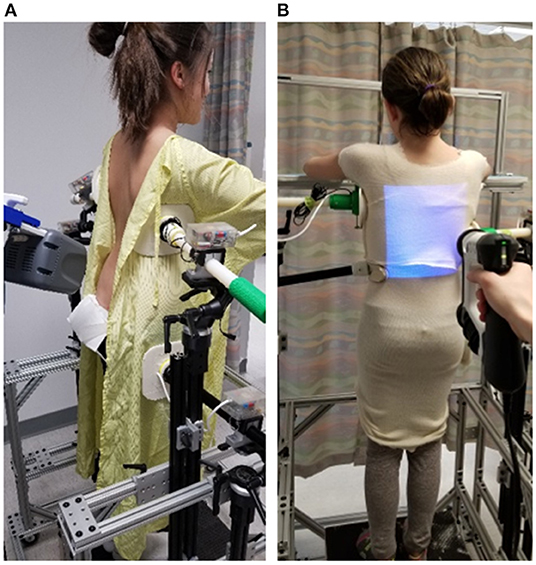 Frontiers | Immediate Outcomes and Benefits of 3D Printed Braces for the  Treatment of Adolescent Idiopathic Scoliosis