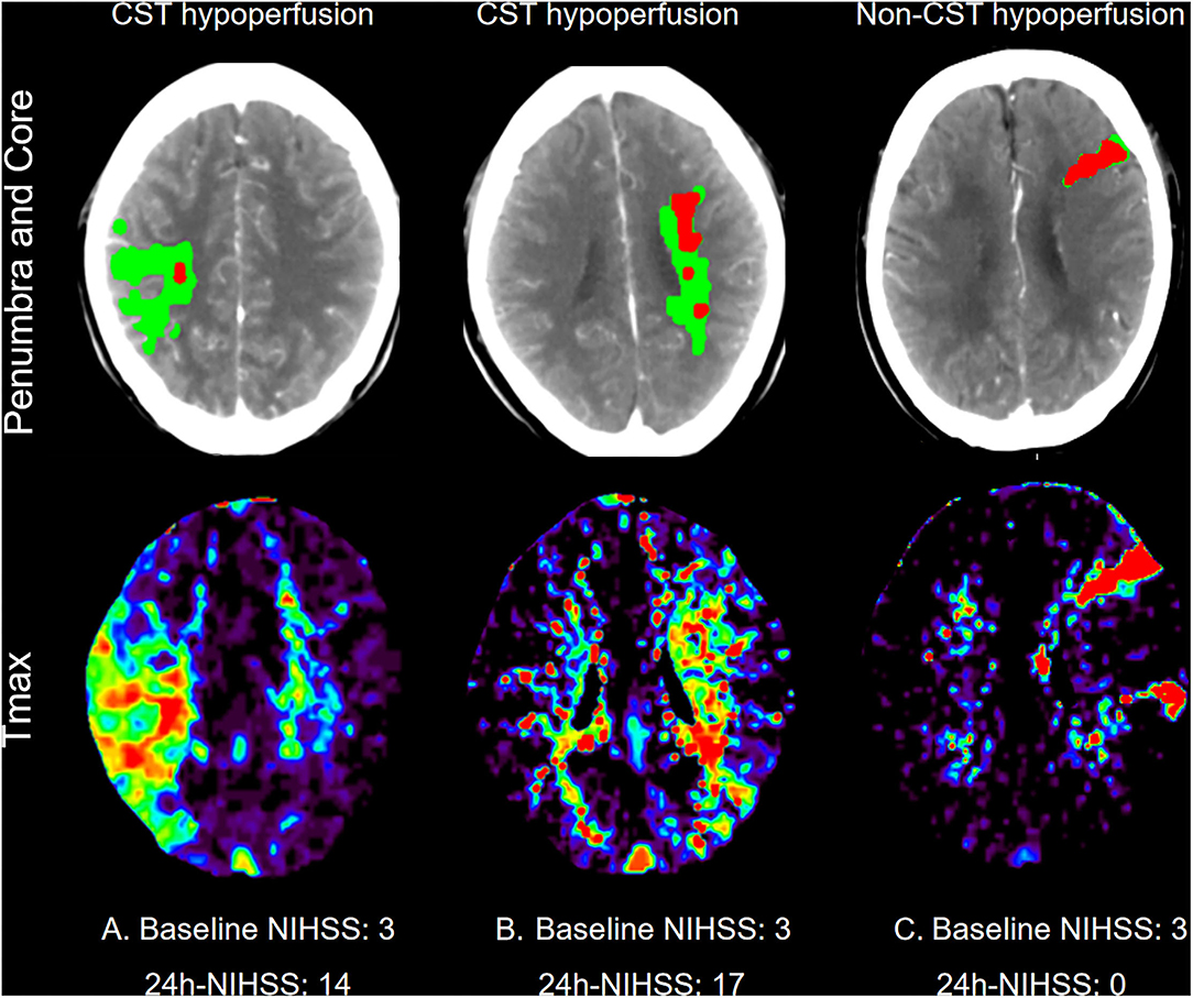 Frontiers | Corticospinal Tract Hypoperfusion Associated