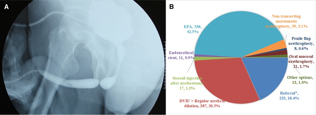 Frontiers | The treatment practices for anterior urethral