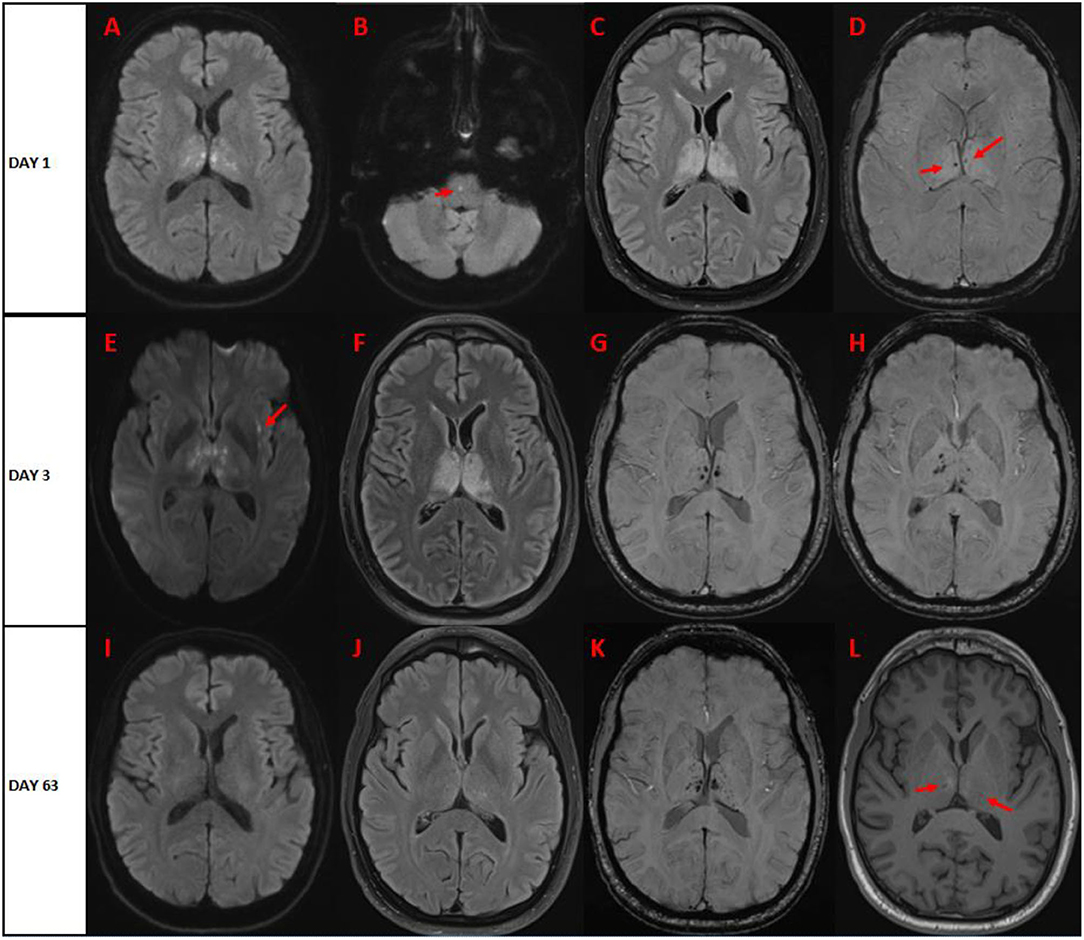 Frontiers | Case Report: Acute Necrotizing Encephalopathy
