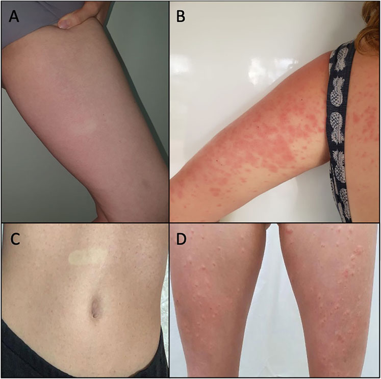 Allergic Reaction To CBD Oil: Symptoms & Solutions