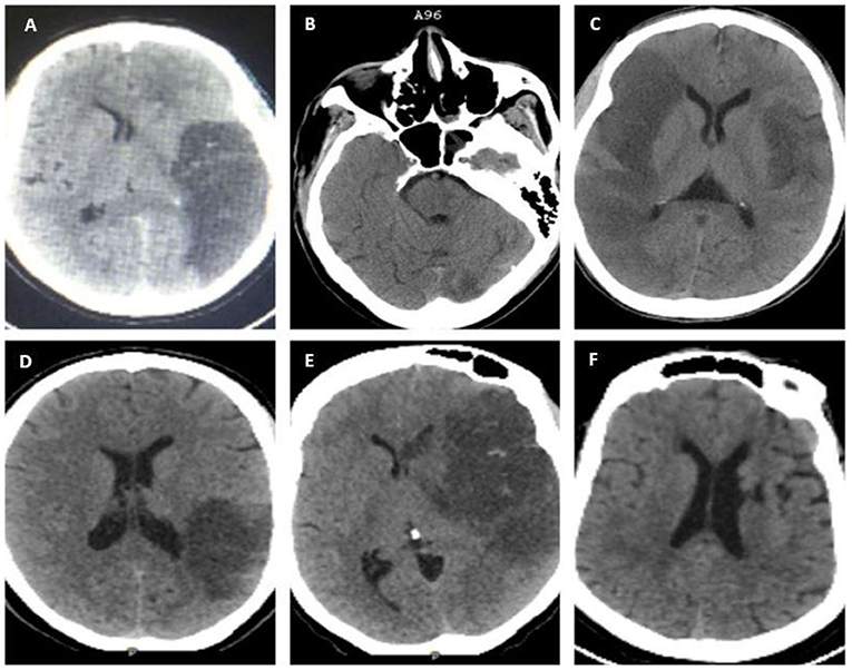 Frontiers | Ischemic Stroke at a Tertiary Academic Hospital