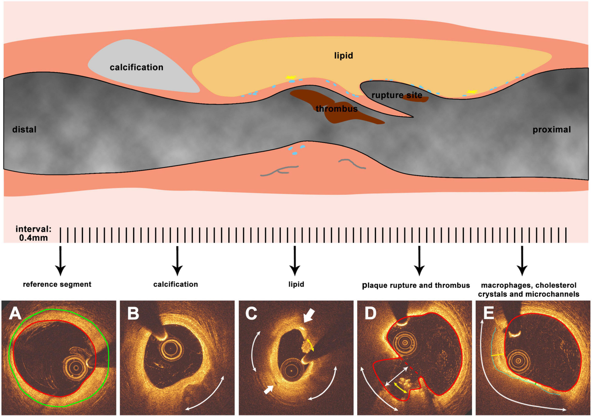 Frontiers Morphological and Physiological Characteristics of Ruptured Plaques in Native