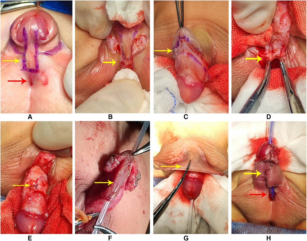 Hypospadias And Chordee