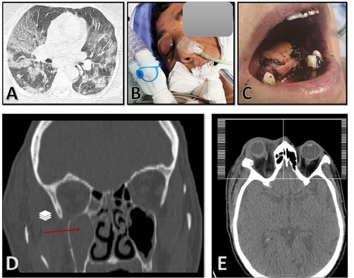 Frontiers | A case of COVID-19-associated rhino-orbito-cerebral