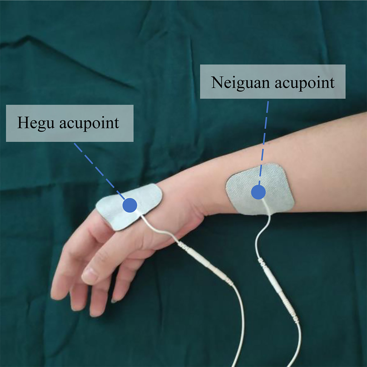 Frontiers | Transcutaneous Electrical Acupoint Stimulation
