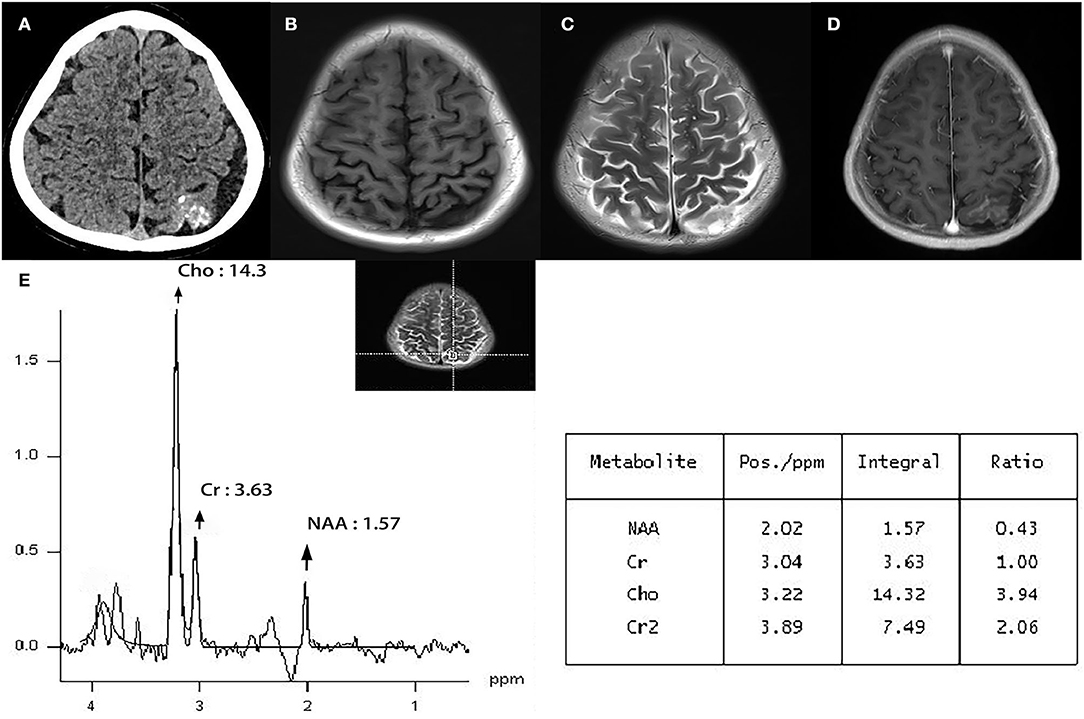 Frontiers | Magnetic Resonance Spectroscopy May Help