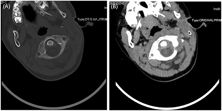 Frontiers | Grisel's syndrome associated with mumps: A case report
