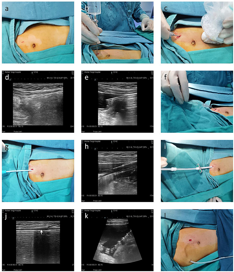 Frontiers | Ultrasound-Guided Modified Seldinger Placement Frontiers | Ultrasound-Guided Modified Seldinger Placement