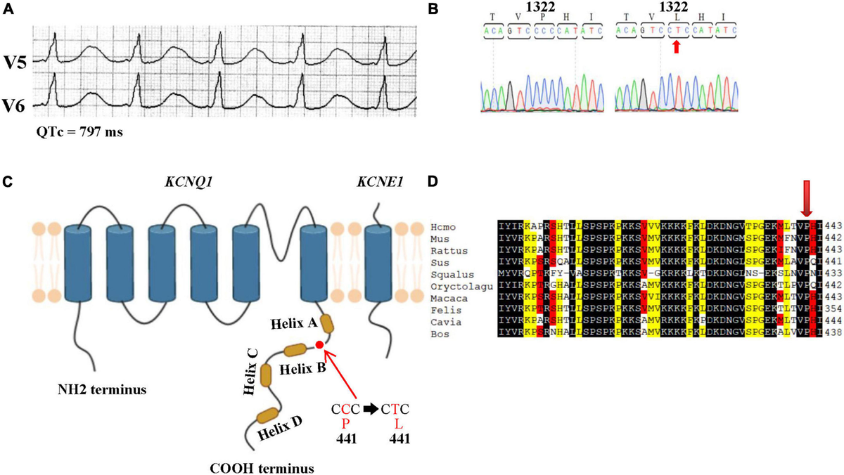 Frontiers | Association of the P441L KCNQ1 variant with
