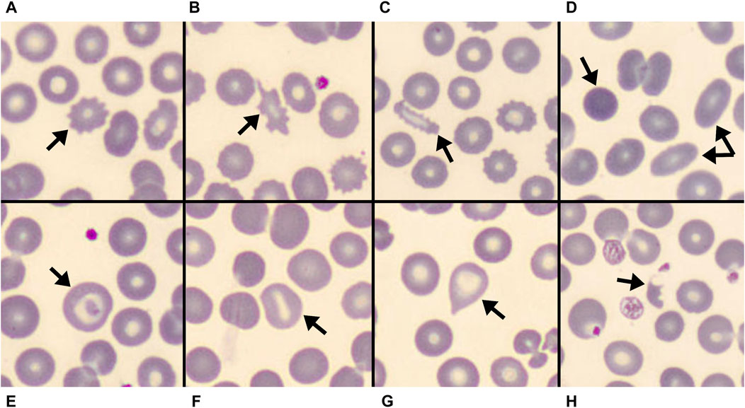 RBC Morphology Interpretation & Blood Film Review | Clinician's Brief