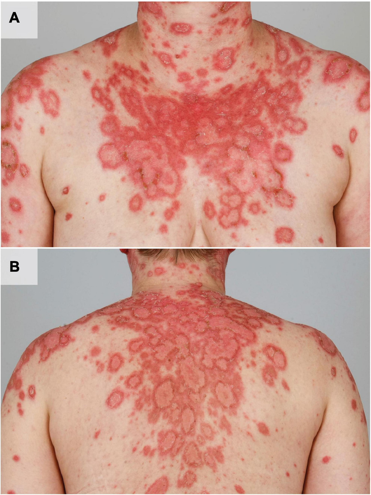 Amazon.co.jp: 〈洋書〉皮膚エリテマトーデス Cutaneous Lupus
