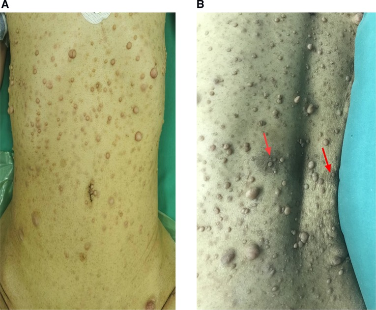 Frontiers | Laparoscopic retroperitoneal resection of the