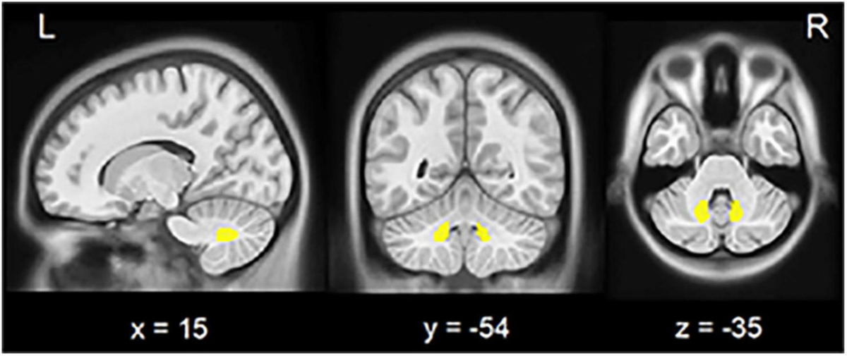 Frontiers | Altered functional connectivity of cerebellar