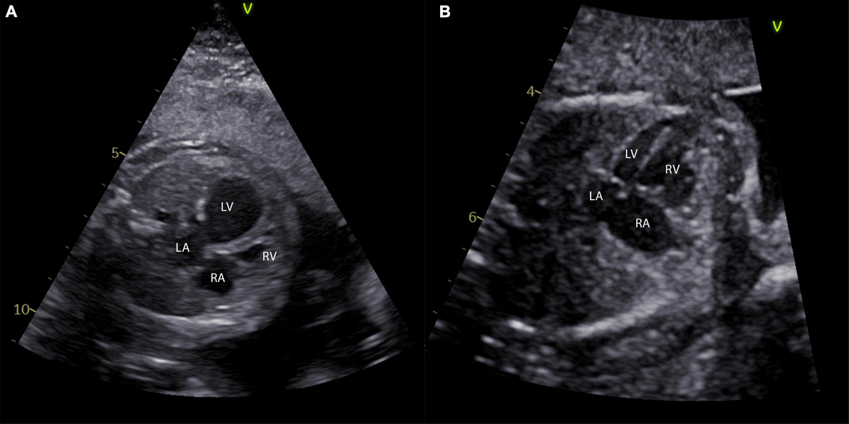 健康・医学 Hypoplastic Left Heart Syndrome Hypoplastic Left Heart Syndrome - Fetal Health Foundation