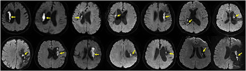 Rapid Assessment of Perfusion–Diffusion Mismatch | Stroke