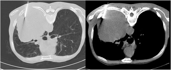 健康・医学 Thoracic Tumours IARC Publications Website - Thoracic Tumours
