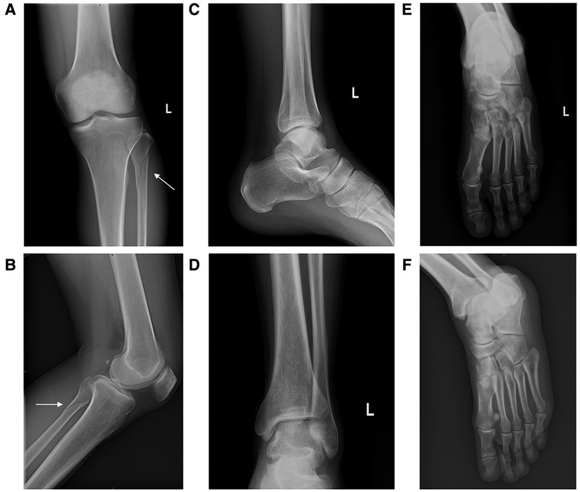 Frontiers | Wearable rehabilitation wristband for distal