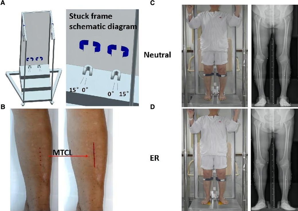 Frontiers | Improved angle accuracy of tibial plateau