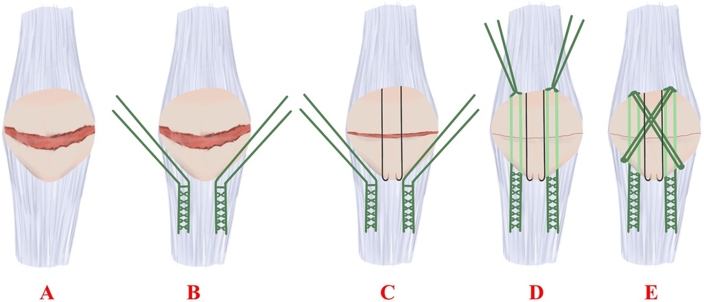 【国内即発送】 Frontiers | Clinical application of Kirschner wires combined 健康・医学