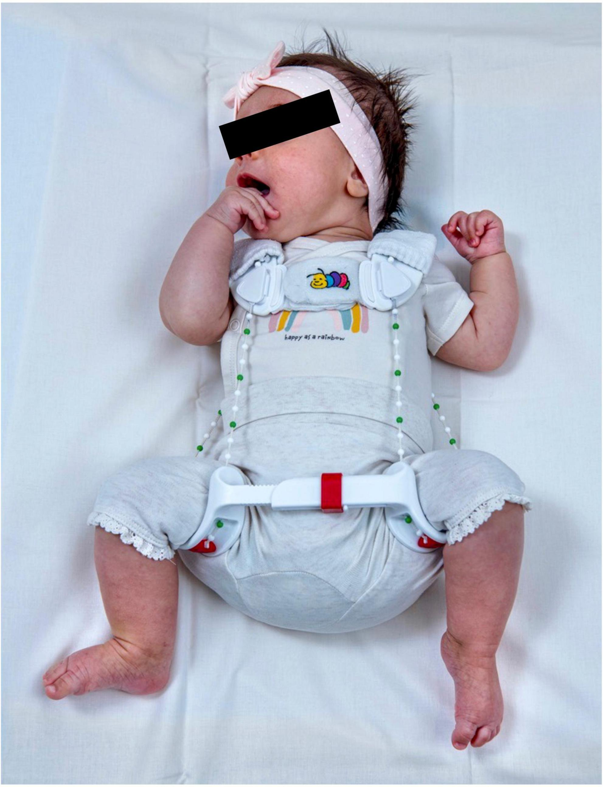 Mild hip dysplasia in babies shop
