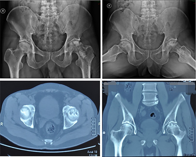 Frontiers | Femoral head metastases from primary mucinous