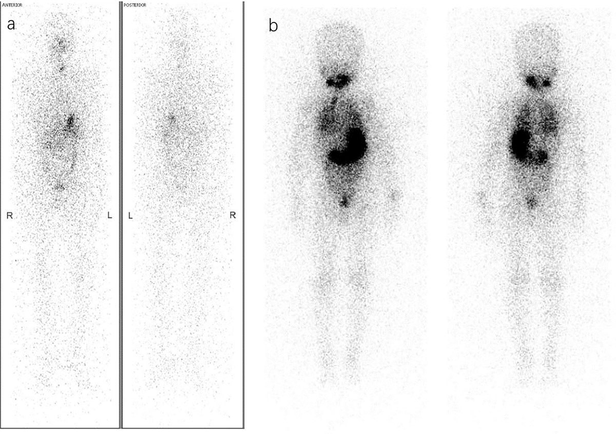 Advances in Functional Imaging of Differentiated Thyroid Cancer