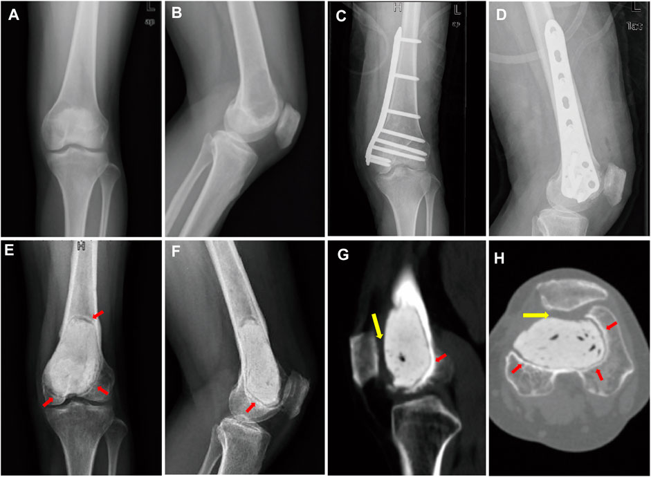 Frontiers | Case Report: Three-dimensional printed