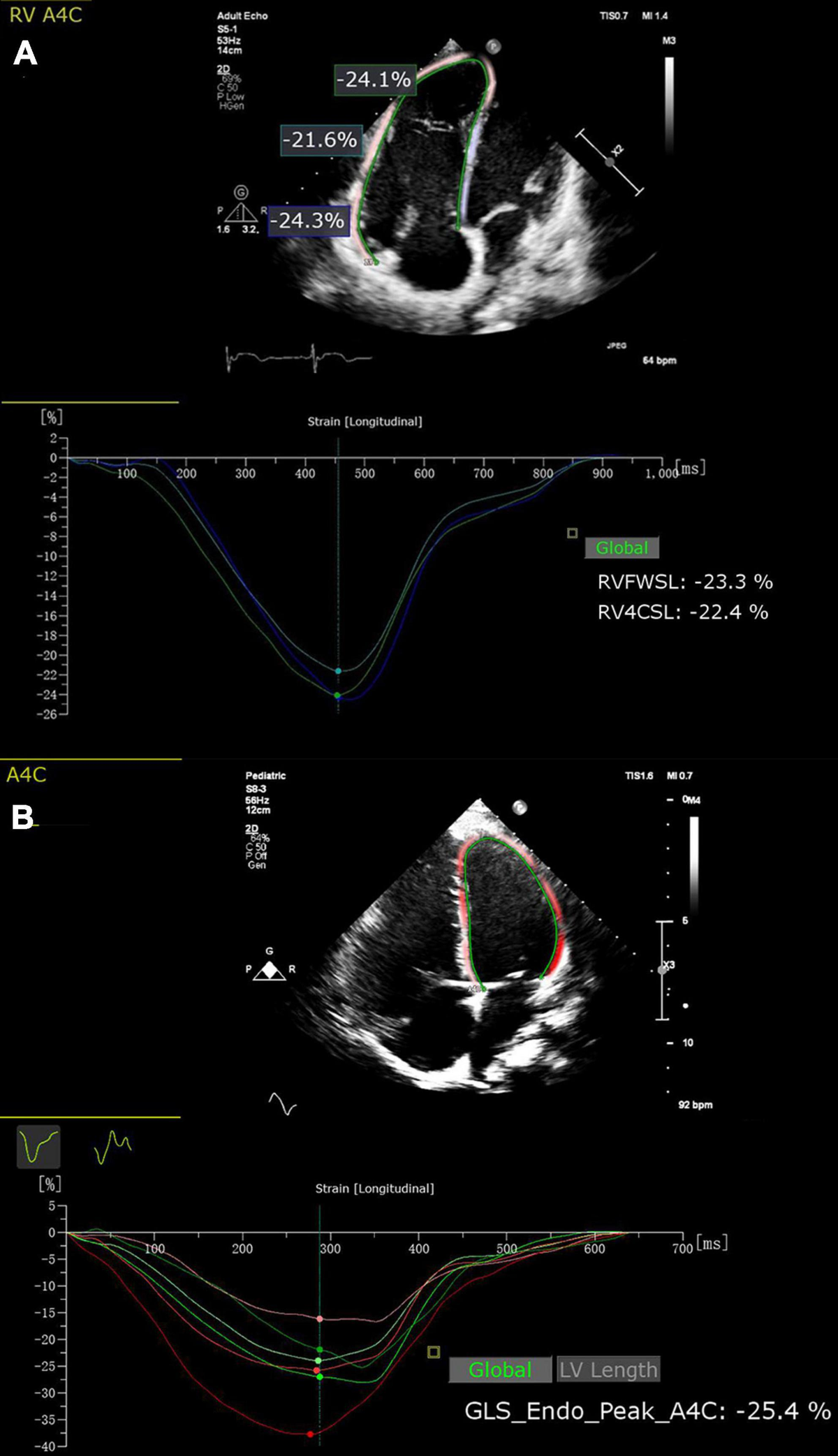 Frontiers Superior prognostic value of right ventricular free wall