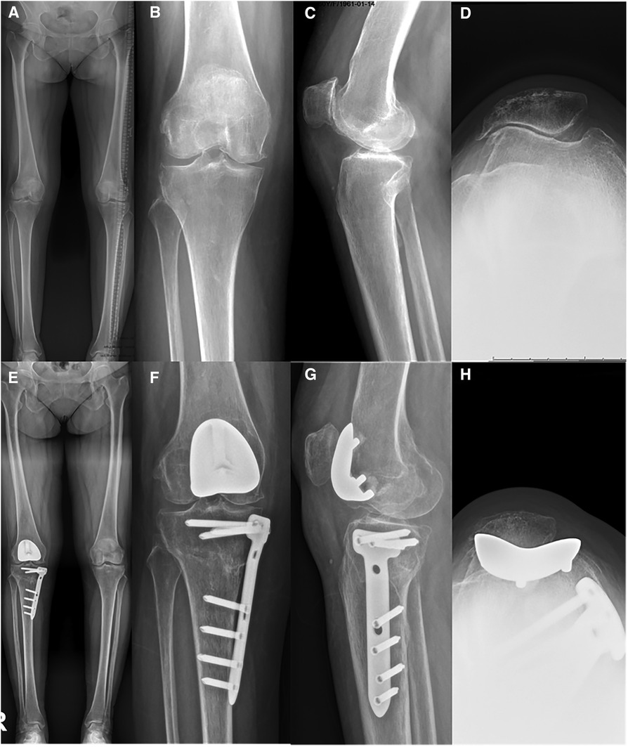 ゼロからはじめる Knee Osteotomyアップデート｜臨床医学外科系