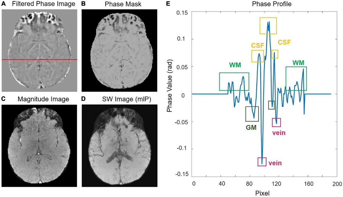 サーナイト　mri CT & MRI: My 78yo Grandma, traumatic aSDH, Docs told she is