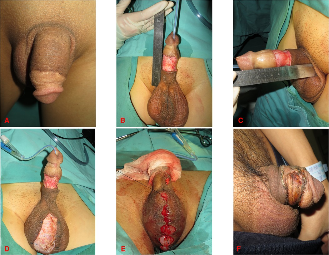 penis without skin Circumcision – GM Urology