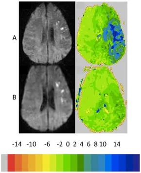 裁断済み　diffusion・perfusion MRI