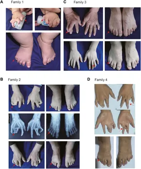 Role of TBX1 in human del22q11.2 syndrome - The Lancet