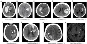 New Insights in Intracerebral Hemorrhage (Frontiers of Neurology and Neuroscience) [ハードカバー] Toyoda， Kazunori? Anderson， Craig S.; Mayer， Stephan A. fneur-14-1176390-g003.jpg