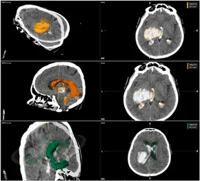 Frontiers | Therapeutic strategies for intracerebral hemorrhage