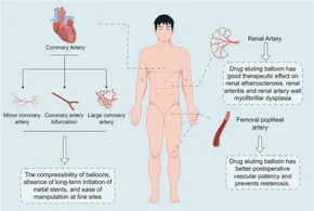 RETEN Research progress of drug eluting balloon in arterial ... - Frontiers fcvm-11-1287852-g003.jpg RETEN Research progress of drug eluting balloon in arterial ... - Frontiers fcvm-11-1287852-g003.jpg