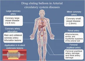 RETEN Research progress of drug eluting balloon in arterial ... - Frontiers fcvm-11-1287852-i001.jpg RETEN Research progress of drug eluting balloon in arterial ... - Frontiers fcvm-11-1287852-i001.jpg
