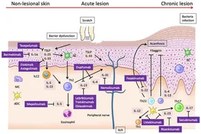 その他 Pathogenesis and Management of Atopic Pathogenesis and management of atopic dermatitis: insights