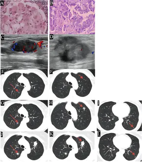 Frontiers | Long-term survival with pemetrexed-based chemotherapy