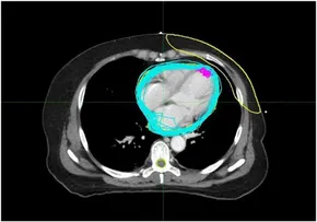 Frontiers | Impact of heart motion on radiation dose in the
