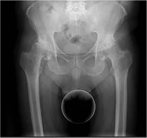 Frontiers | One-stage vs. two-stage bilateral total hip