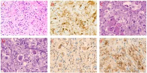 gaoo!!!様 Frontiers | Case report: Primary subcutaneous Rosai-Dorfman