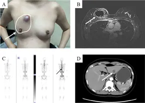 健康・医学 Breast Cancer Proteomic insights into breast cancer response to brain cell
