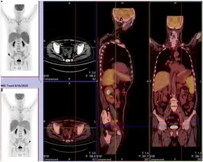 Frontiers | Treatment of relapsed or refractory Hodgkin's