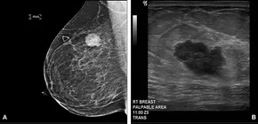 健康・医学 Preneoplasia of the Breast Breast Cancer Screening (PDQ®): Screening - Patient